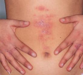 Atopic dermatitis (eczema) picture