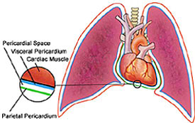 Pericarditis & Pericardial Disease