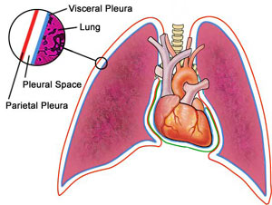 Pleural effusion