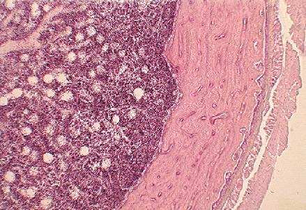 Bone Marrow Transplant