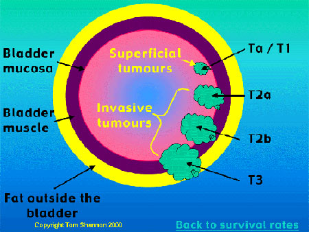 Transitional cell carcinoma of the Bladder