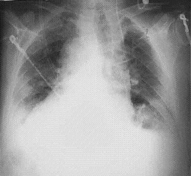 x-ray of Pleural Effusion