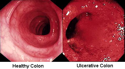 Ulcerative colitis picture