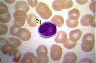 Waldenstrom's Macroglobulinemia