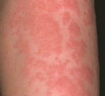 Hives - Urticaria