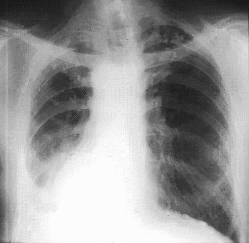 Asbestosis x-ray image