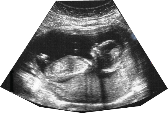 Ultrasound of a fetus