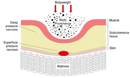 Pressure Ulcers