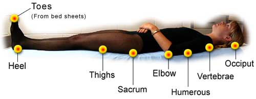 Supine Position Reduces Pressure Ulcers