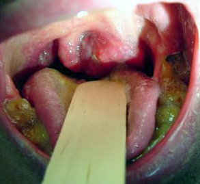 Squamous Cell Carcinoma of the Tonsil