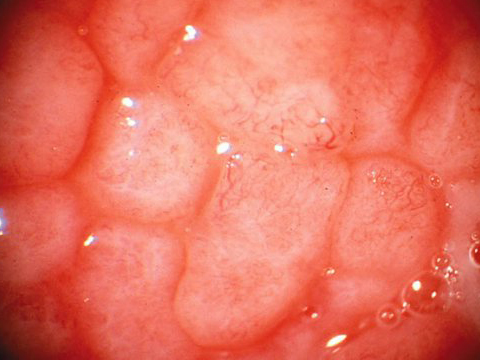 Hypersensitivity reaction - Type I