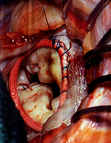 Mitral Regurgitation