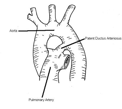 Patent Ductus Arteriosus - PDA