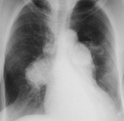 Pulmonary Hypertension