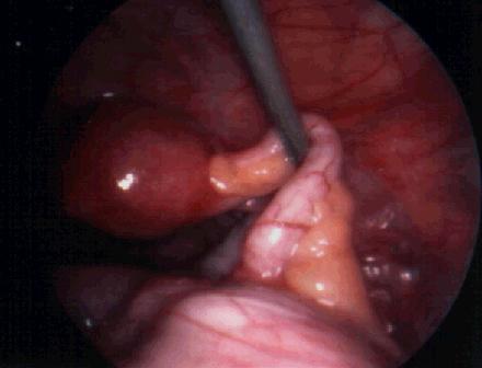 Appendicitis image