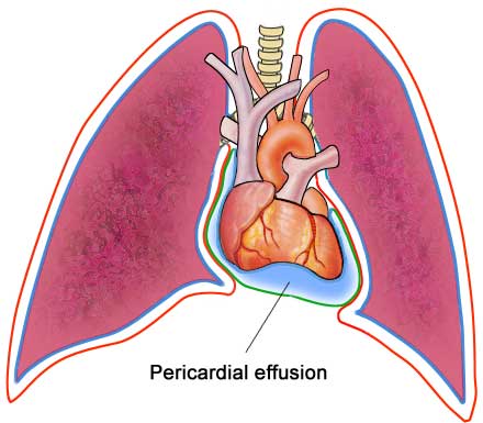 cardiac tamponade symptoms