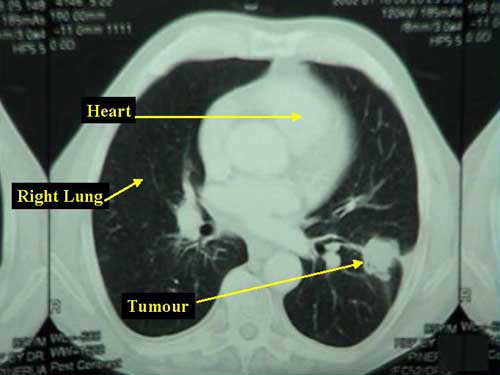 Squamous Cell Carcinoma of the Lung