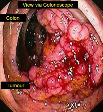 Colon cancer