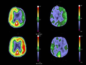 Example of PET scan