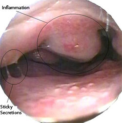 Allergic Rhinitis - Hay fever