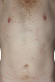 Chickenpox pictures