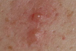 Shingles pictures