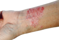 Psoriasis image