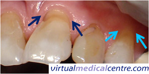 Figure 1: Abrasion lesions