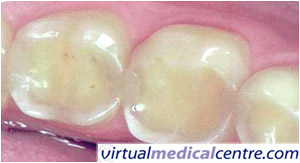 Figure 5a: Posterior dental erosion