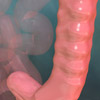 Crohn's disease picture