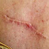 Scar image