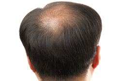 Video: Hair loss
