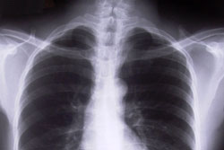 Chest x-ray