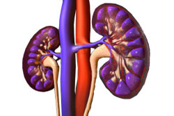 Kidney transplant