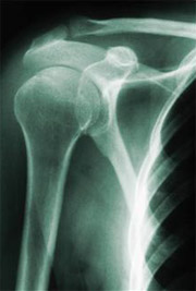 Shoulder dislocation and instability image