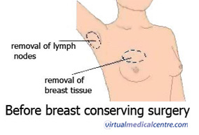 Before breast conserving surgery