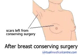 After breast conserving surgery