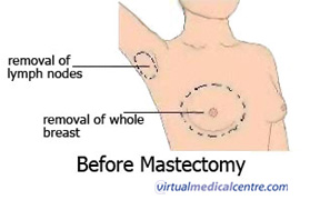 Before mastectomy