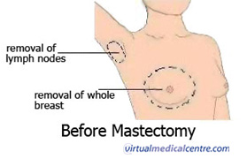 Halsted Radical Mastectomy, Incision T-Shirt