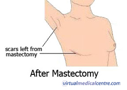 After mastectomy