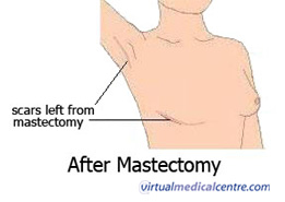 Halsted Radical Mastectomy, Incision T-Shirt