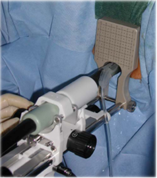 Figure 1: Ultrasound probe mounted in stepper with template attached. Probe inserted in rectum.
