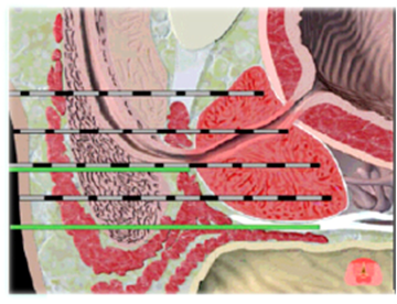 Figure 3: Lateral view of freezing needles and thermocouple (green) in prostate.