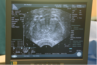 Figure 4: Ultrasound image (transverse) of prostate with needles in place.