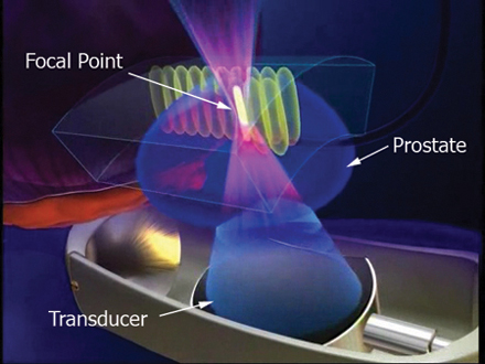 High intensity focused ultrasound