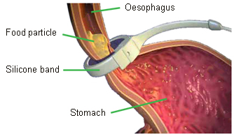 LAP-BAND on stomach