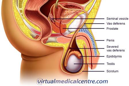 Vasectomy