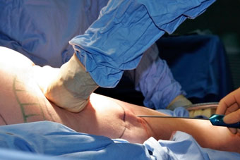 Liposuction Procedure