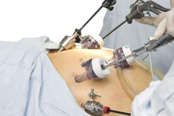 Bariatric surgery