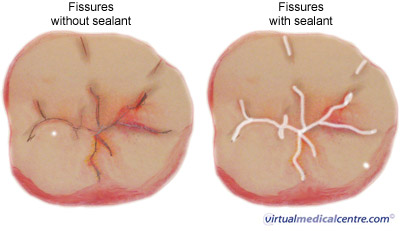 Fissures and tmel picture